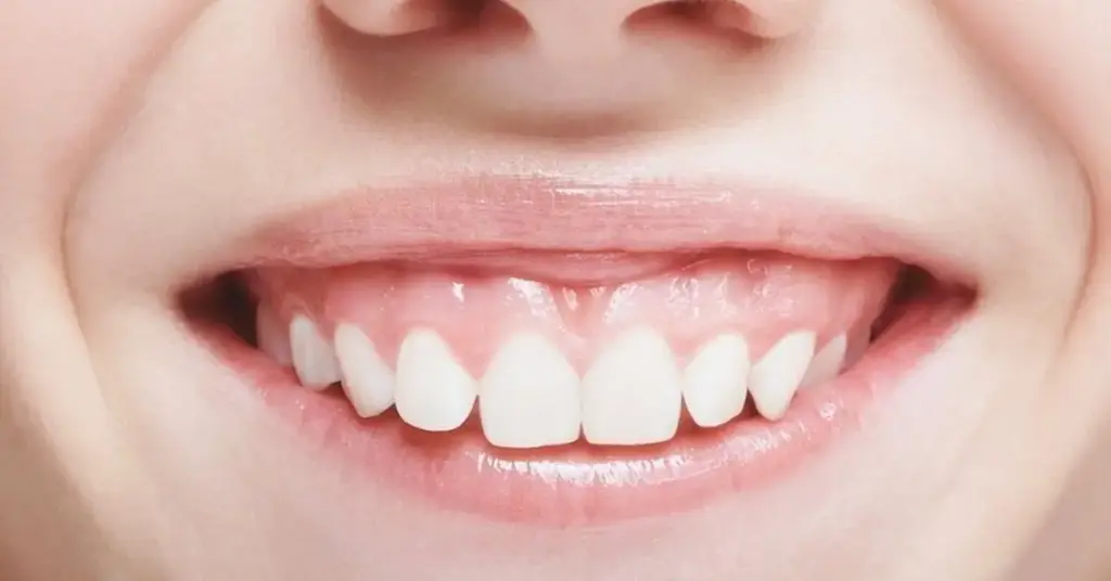 what gummy smile 