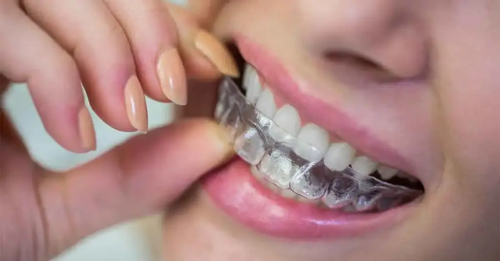 Clear Aligner Treatment