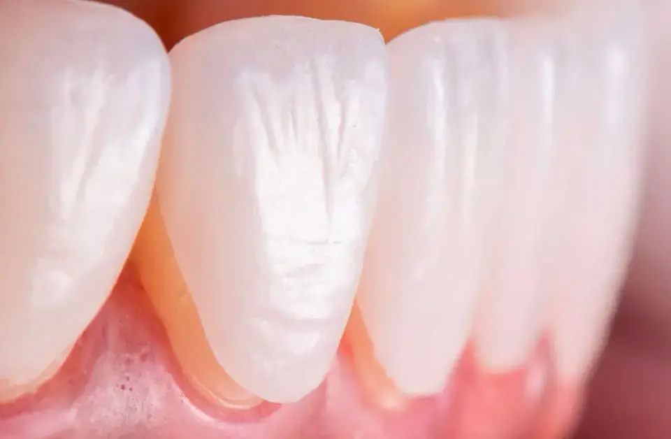 Porcelain Laminate care