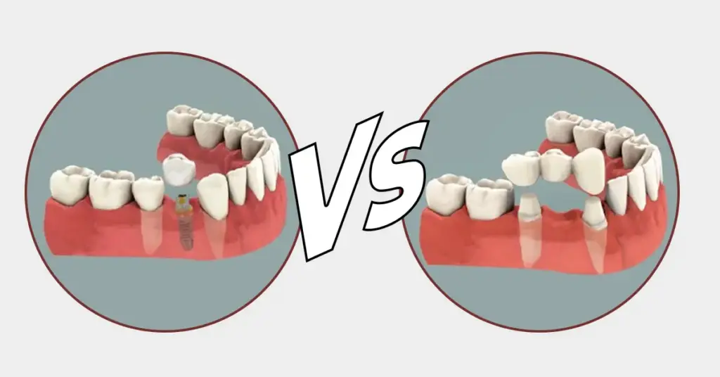 Single dental tooth or dental bridge
