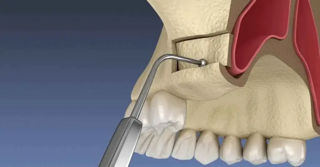 Sinus Lift Treatment
