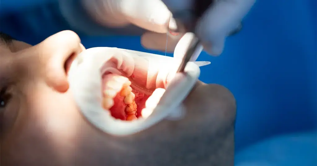 What-is-revision-root-canal-treatment