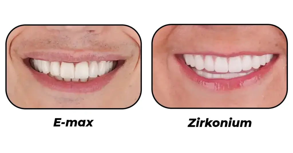 Zirconium or Emax-Aesthetics