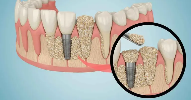 Bone graft and PRF
