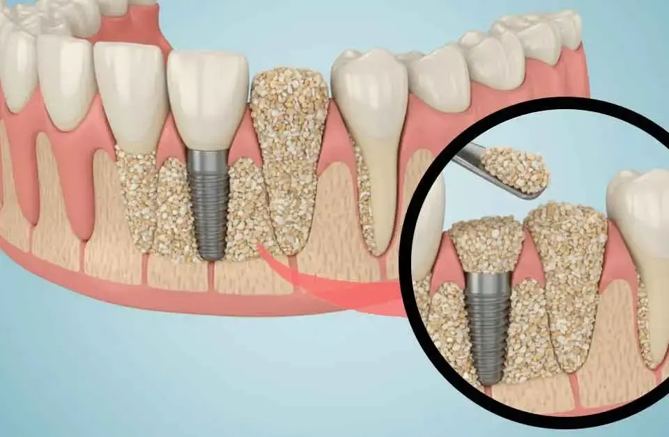 Bone graft and PRF