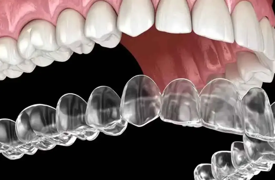 Clear Aligner Treatment
