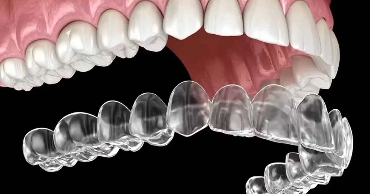 Clear Aligner Treatment