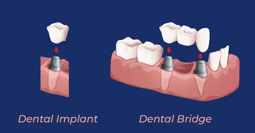 Dental Bridge or Dental implant