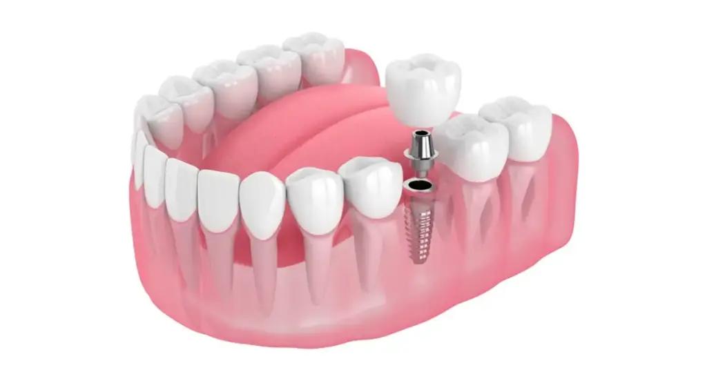 Single dental implant 