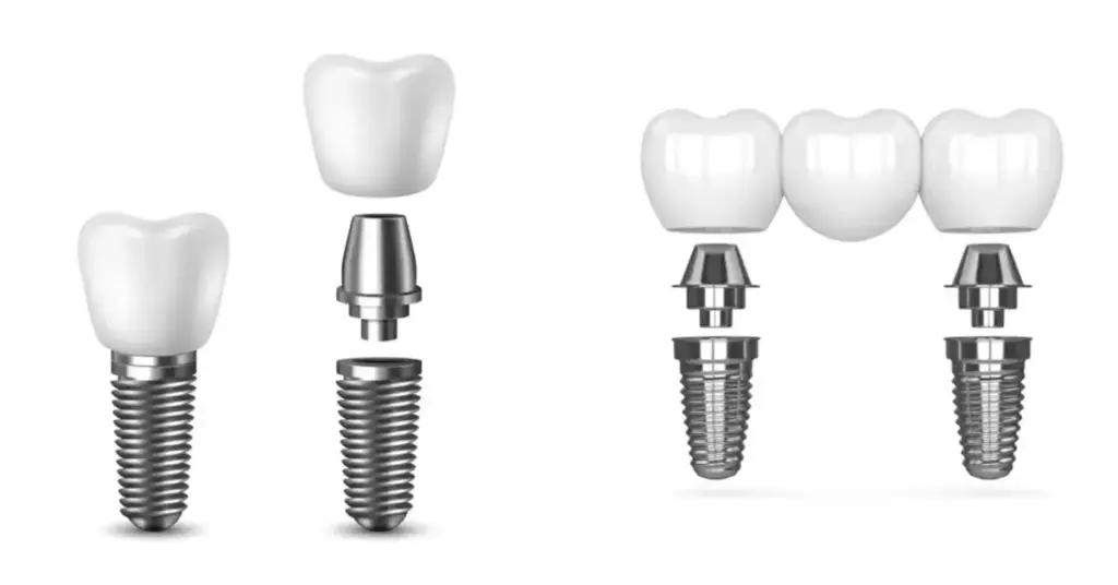 Single dental implant or dental bridge 