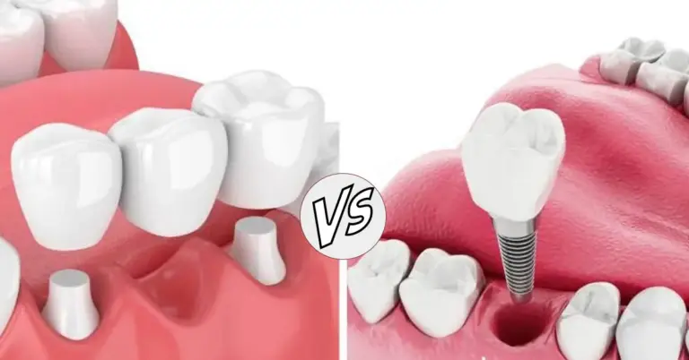 Single Tooth Implant or Dental Bridge?