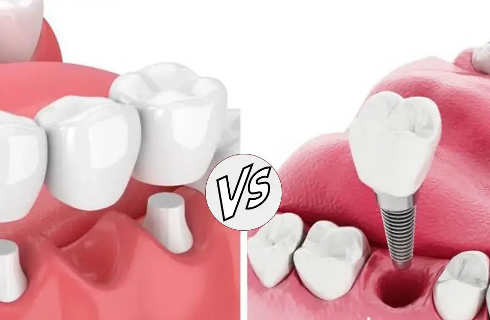 Single Tooth Implant or Dental Bridge?