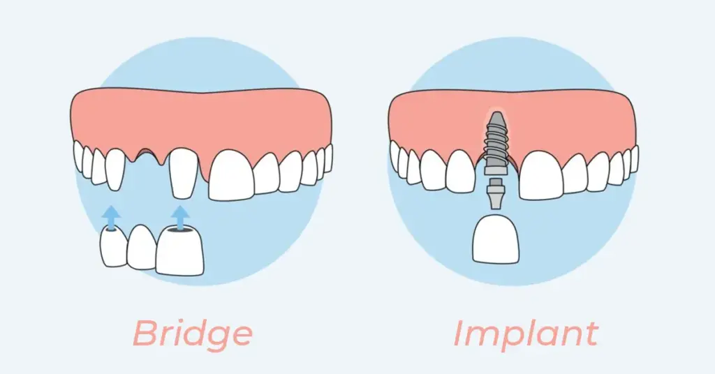 Dental implant vs Dental bridge 
