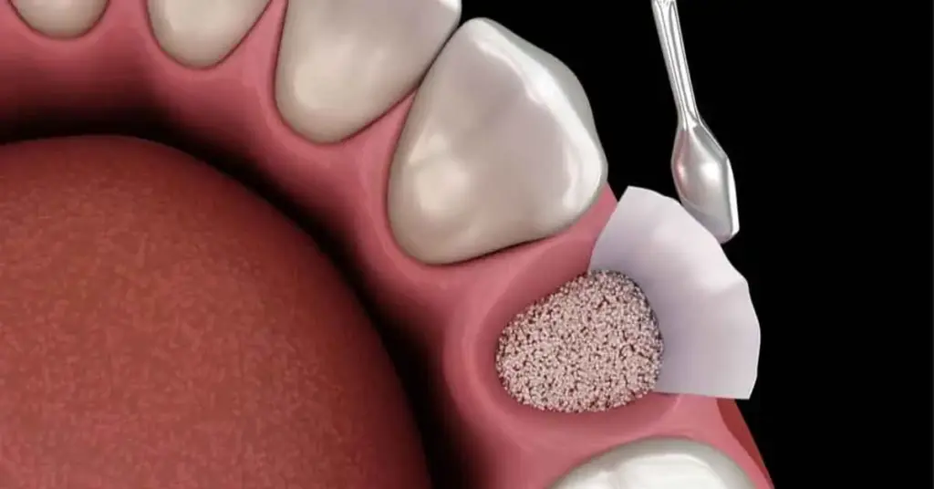 jawbone-powder-treatment