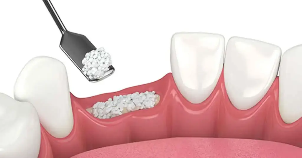 jawbone-power-dental-treatment