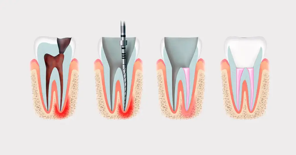 revision-root-canal-treatment-stages