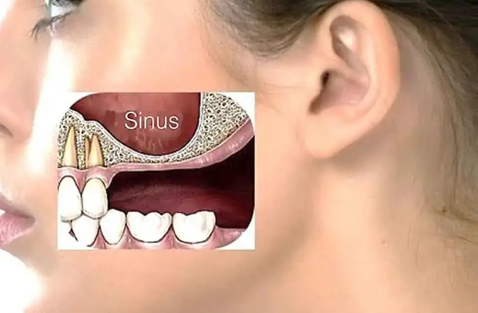 Sinus Lift
