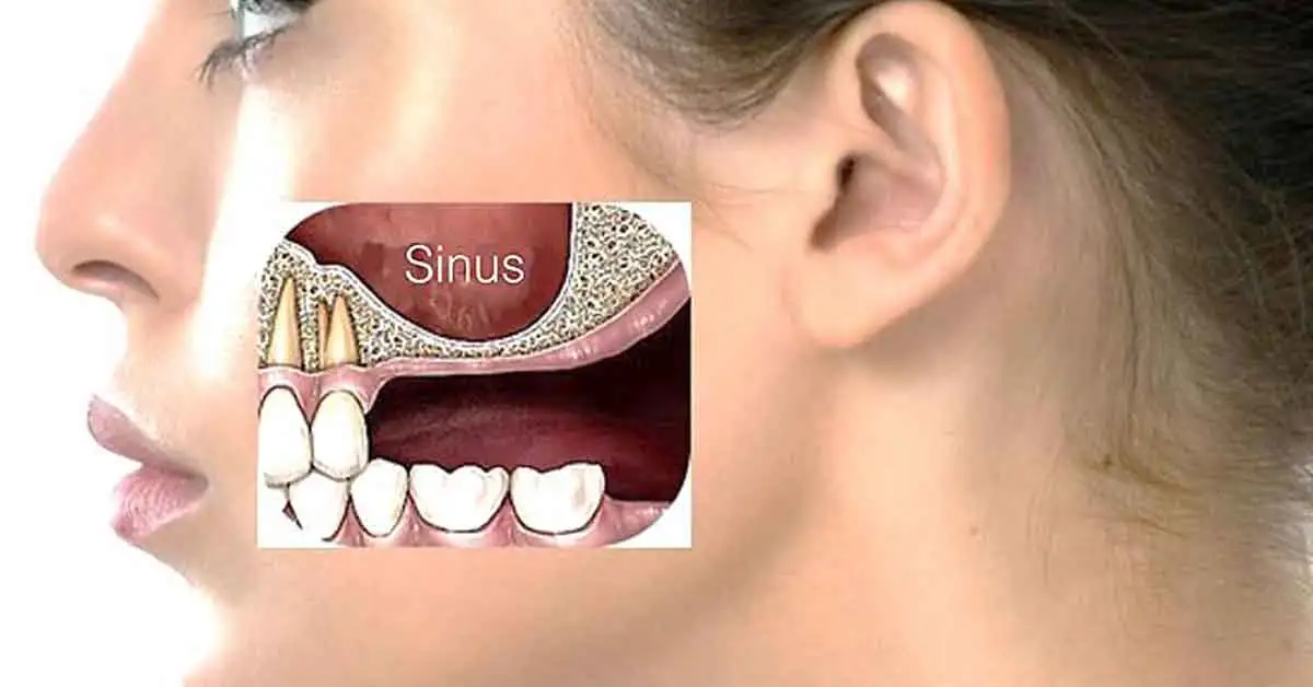 Sinus Lift