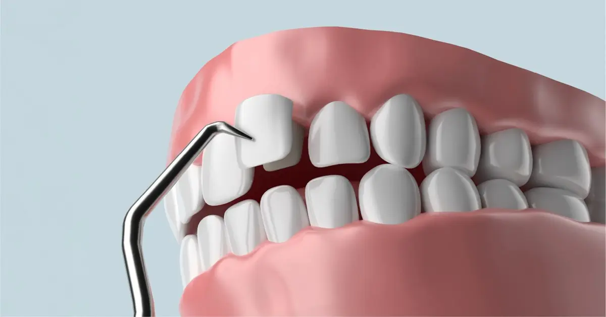 Срок службы шпона