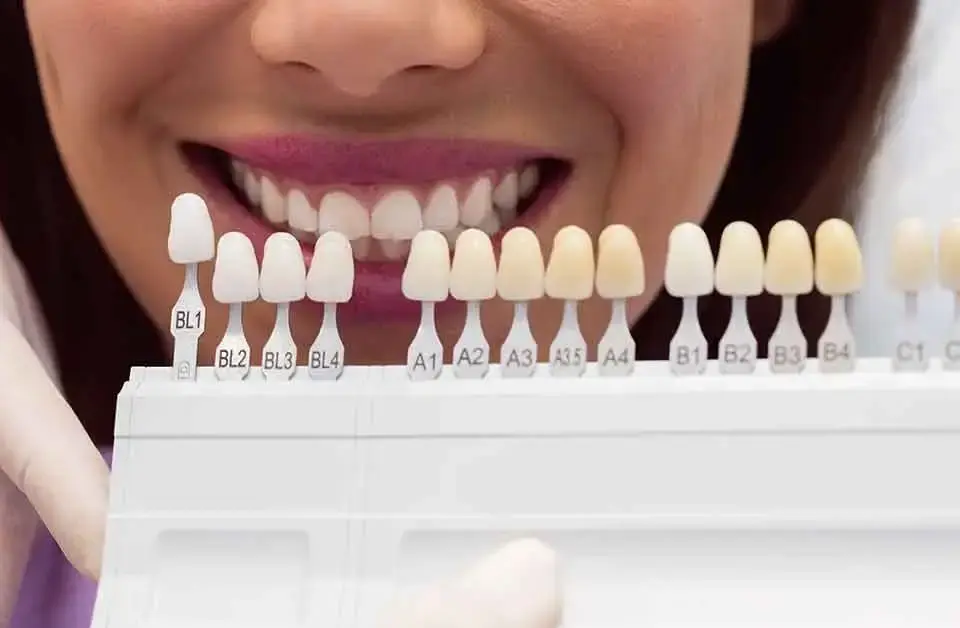 Porcelain Crowns Shade Selection