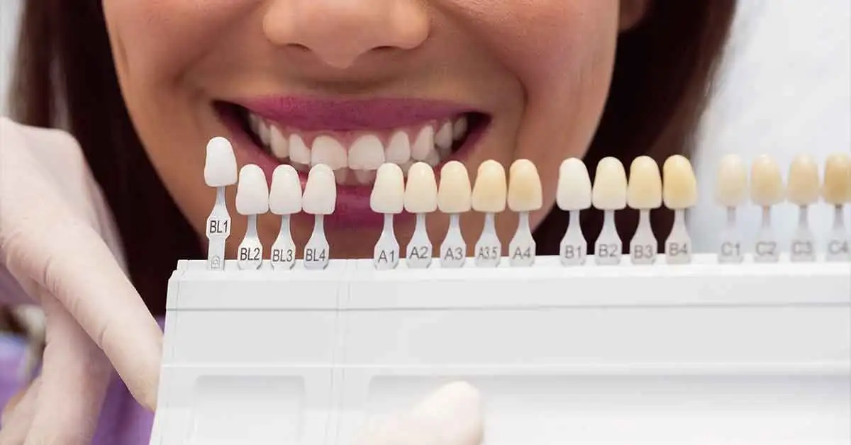 Выбор оттенка фарфоровых коронок