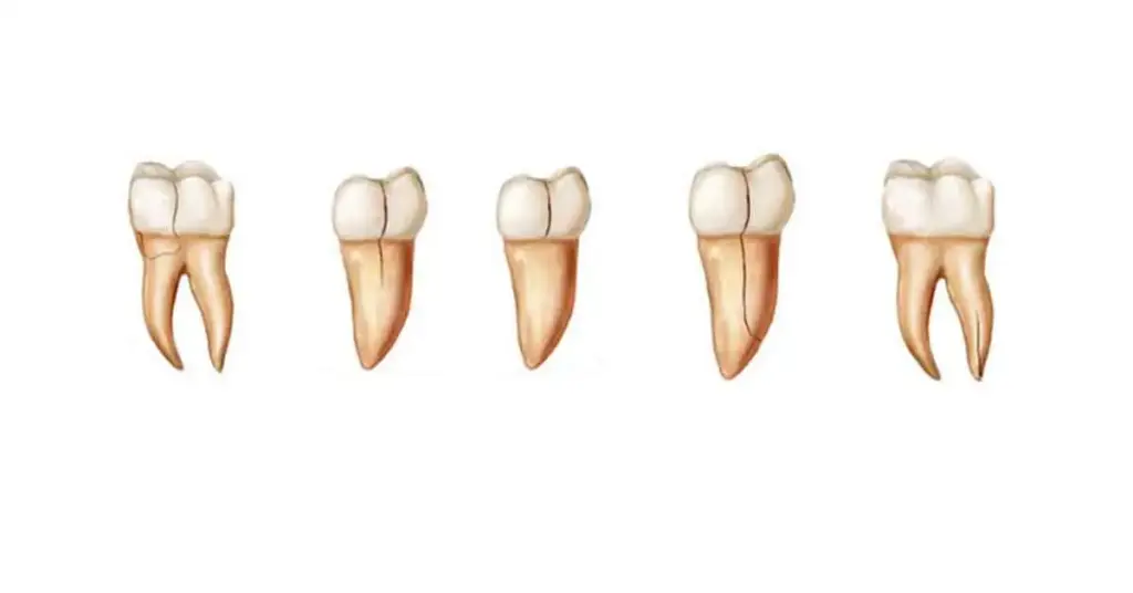 cracked tooth syndrome