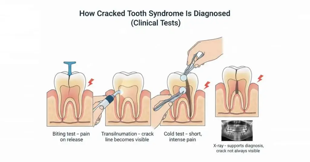 cracked tooth syndrome test