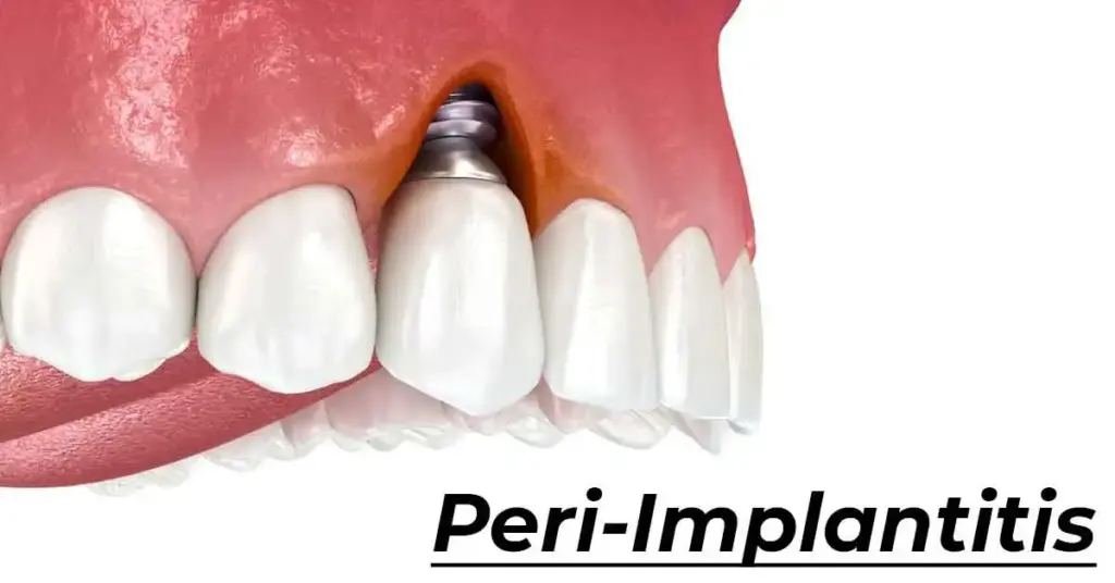 peri implantitist