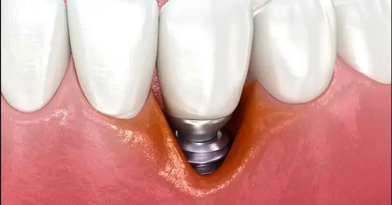peritit implantı