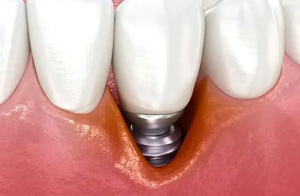 peritit implant