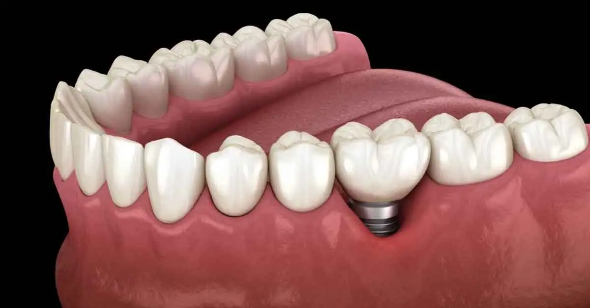 prevent peri implantitis