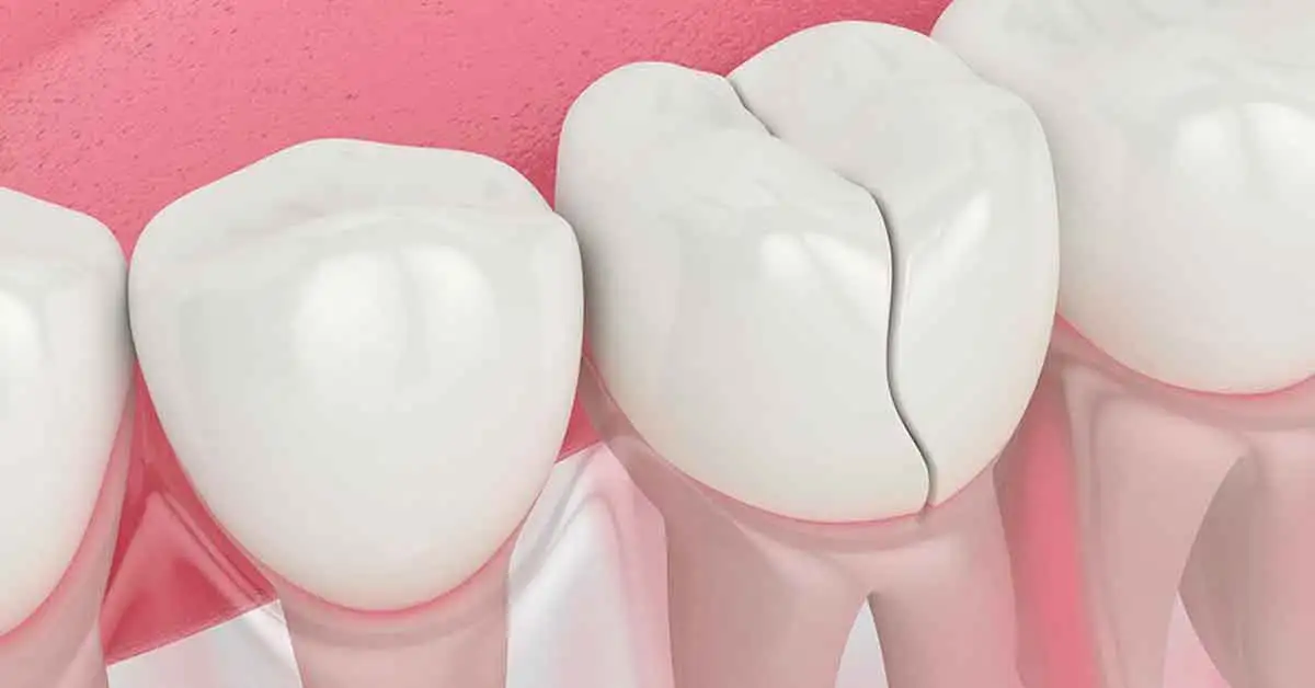 Cracked-Tooth-Syndrom