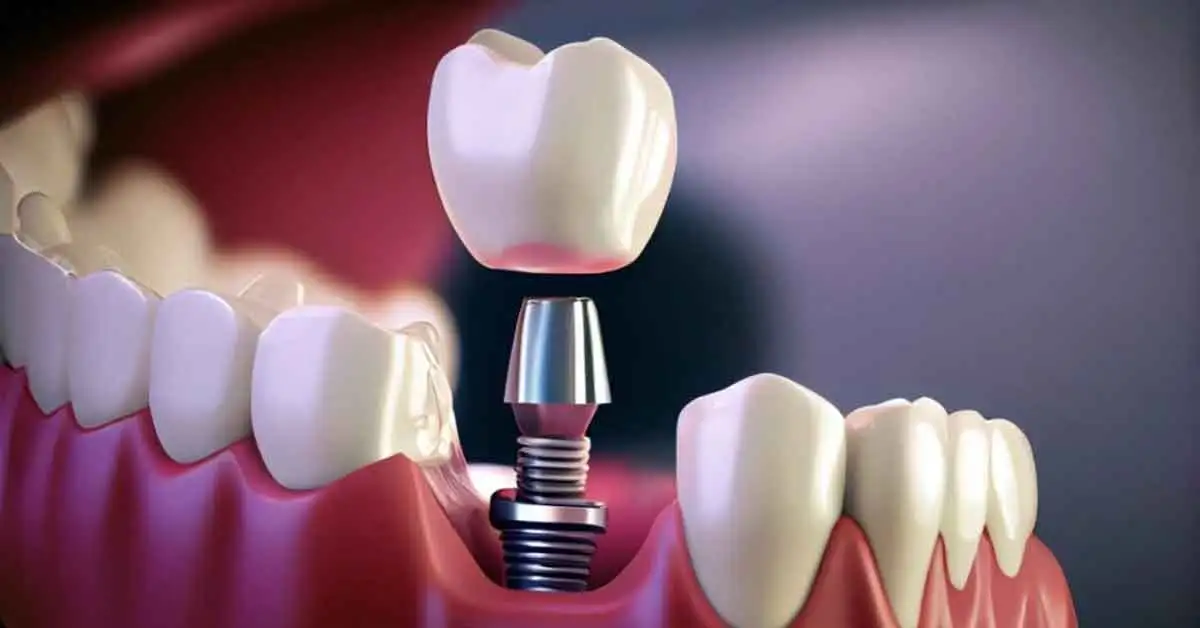 BioHorizons dental implants
