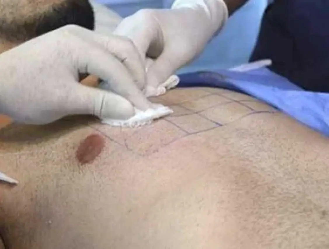 Body Hair Transplant