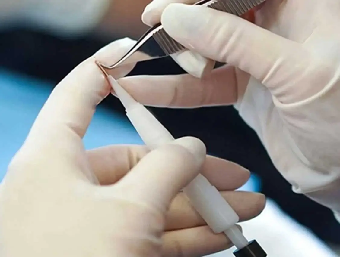 DHI Hair Transplantation