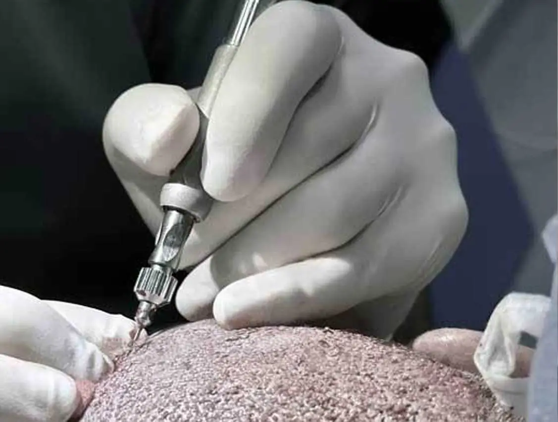 Manuel Fue Hair Transplant