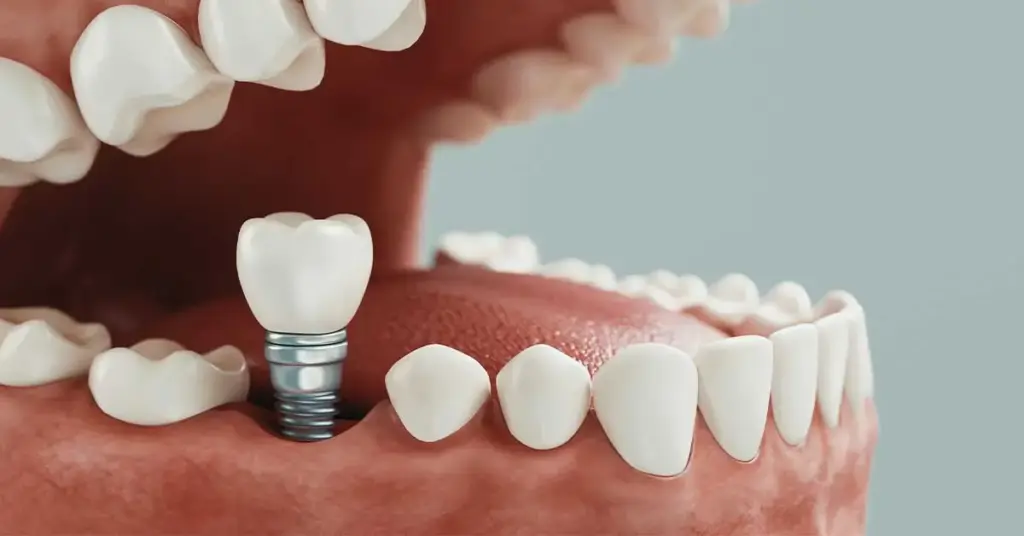Dental Implants