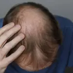 DHT-Related Hair Loss