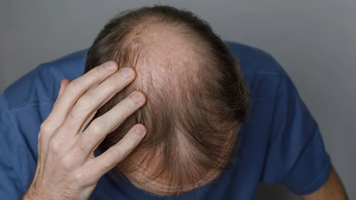 DHT-Related Hair Loss