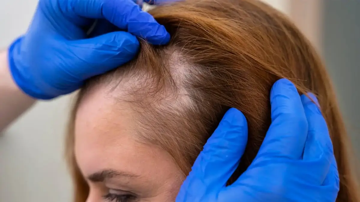 DHT-Related Hair Loss