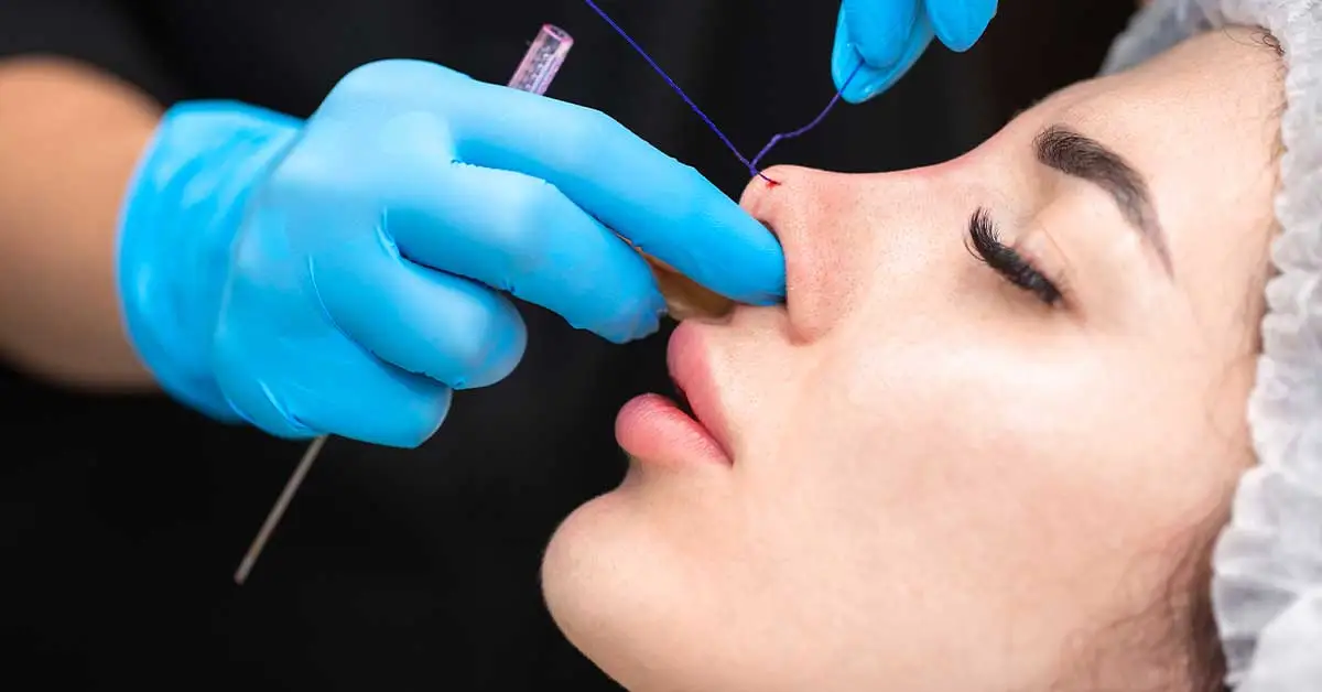 Rhinoplasty
