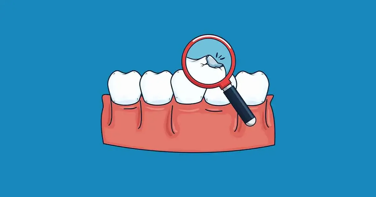 Broken tooth fragment stored correctly in a clean container for dental care