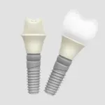 Dentsply Sirona Dental Implants