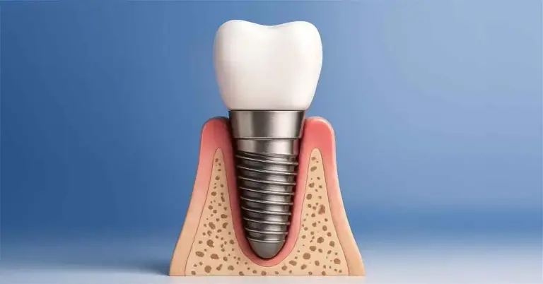 Euroteknika dental implant treatment consultation at Niva Aesthetic