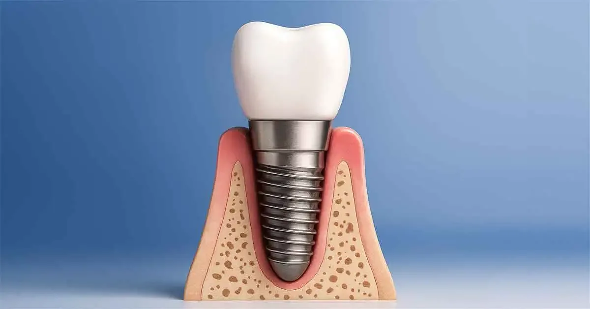 Euroteknika dental implant treatment consultation at Niva Aesthetic