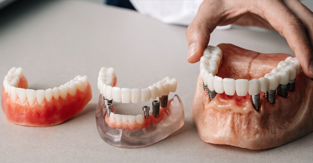 Three realistic dental models showing conventional denture, implant overdenture, and fixed implant-supported teeth