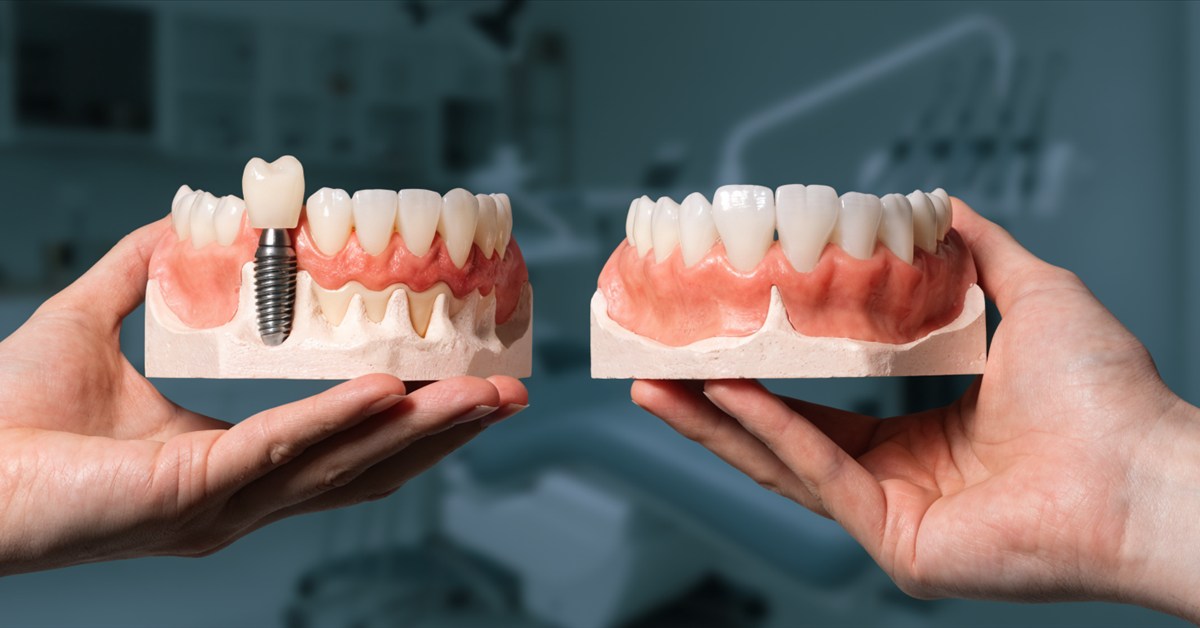 Dentist comparing a single implant model with a traditional dental bridge model