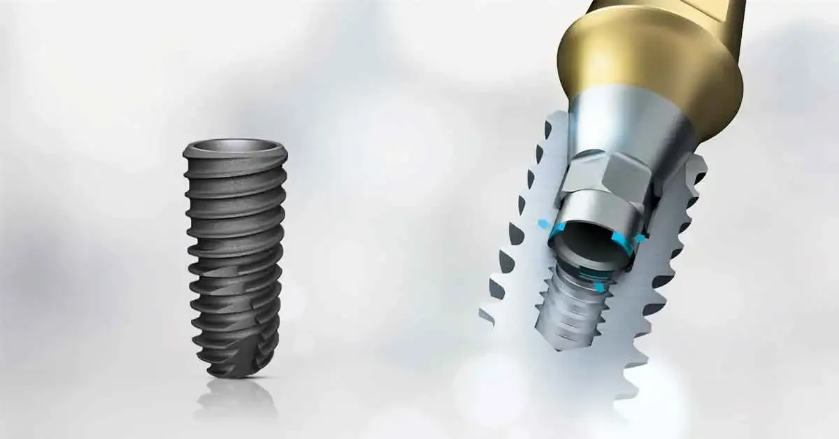 Dentist explaining Osstem dental implant function and treatment planning with a jaw model