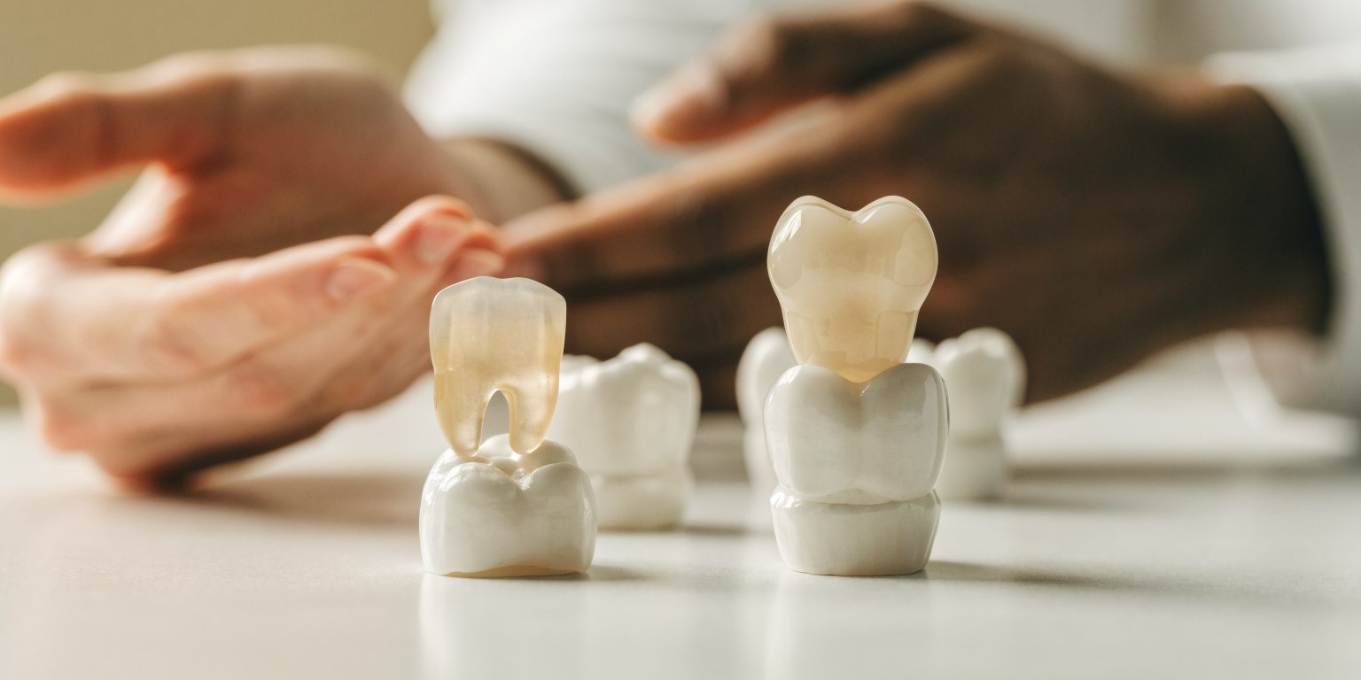Dentist explaining E-max and zirconia material selection during a Hollywood Smile consultation
