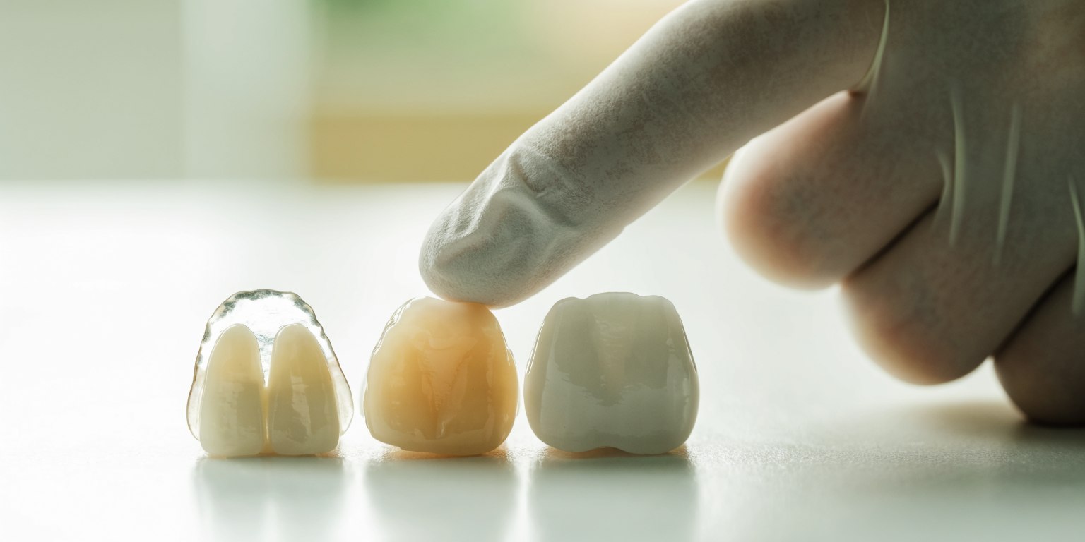 Dental models illustrate differences between composite, ceramic veneer and crown designs